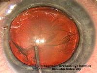 Hydrodissection and hydrodelineation